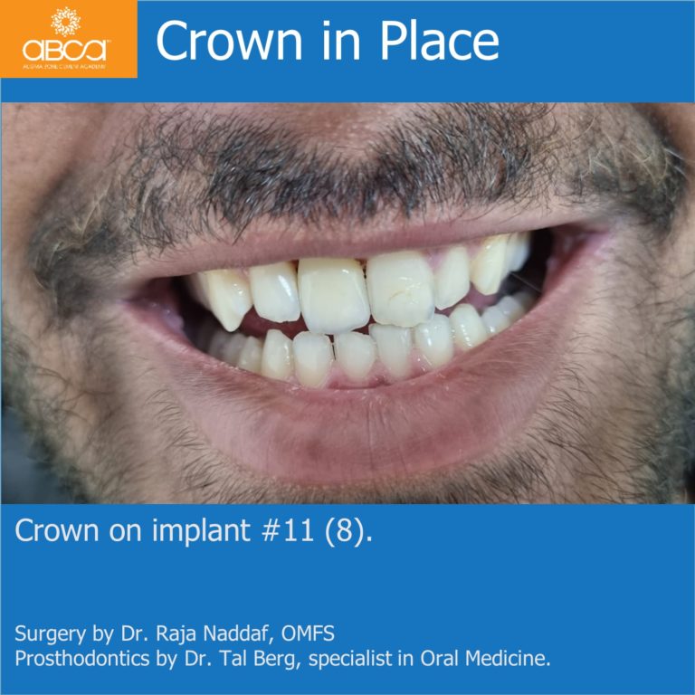 Implant and Augma in the Aesthetic Zone